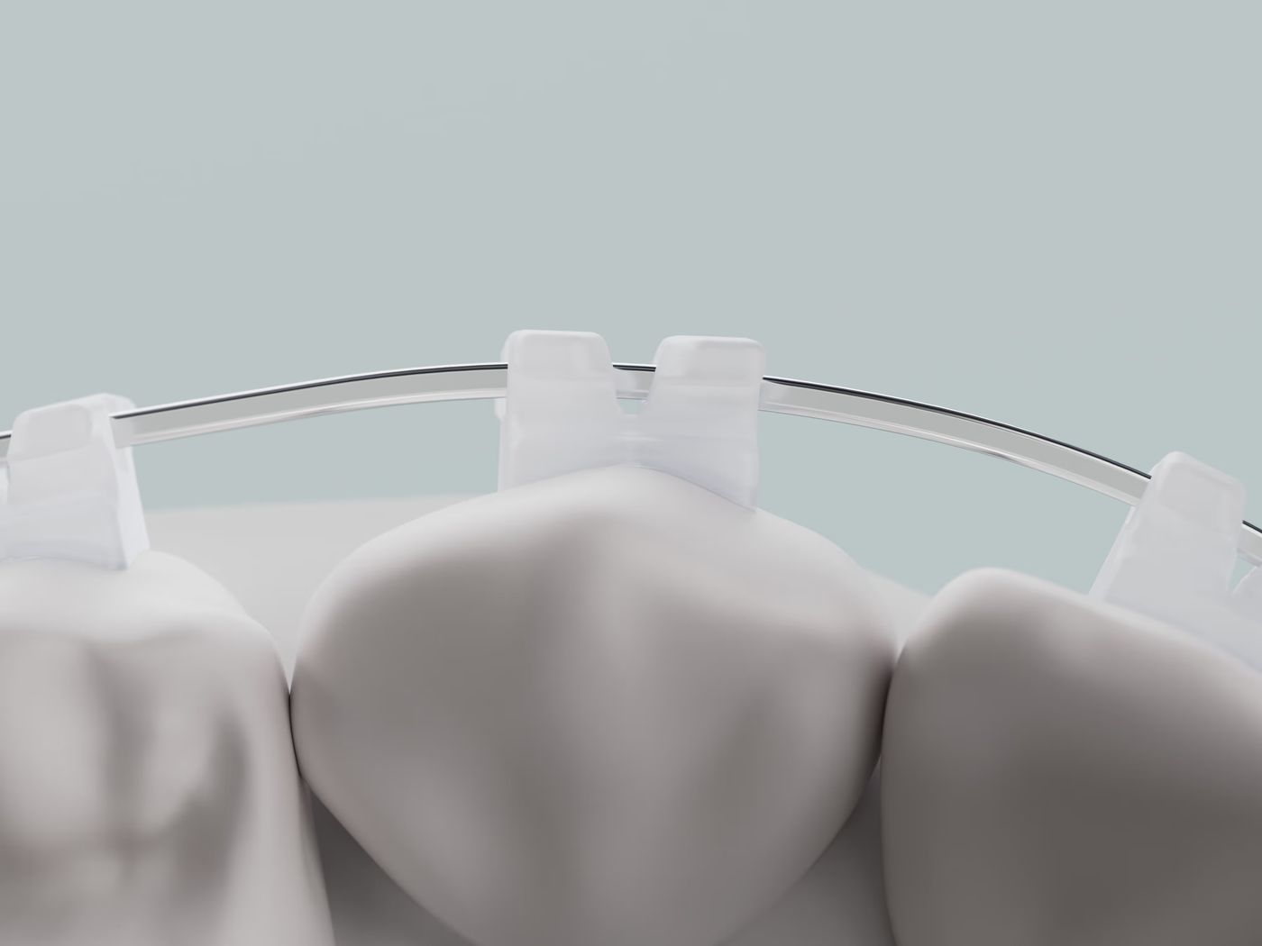 LightForce custom brackets fitted to the shape of each tooth