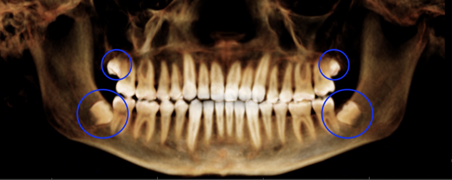 Radiograph with wisdom teeth circled, showing limited room to erupt